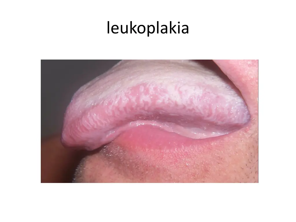 leukoplakia