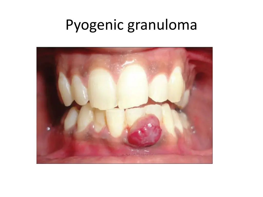 pyogenic granuloma 2