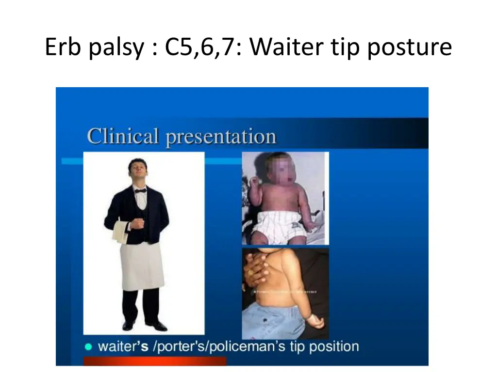 erb palsy c5 6 7 waiter tip posture
