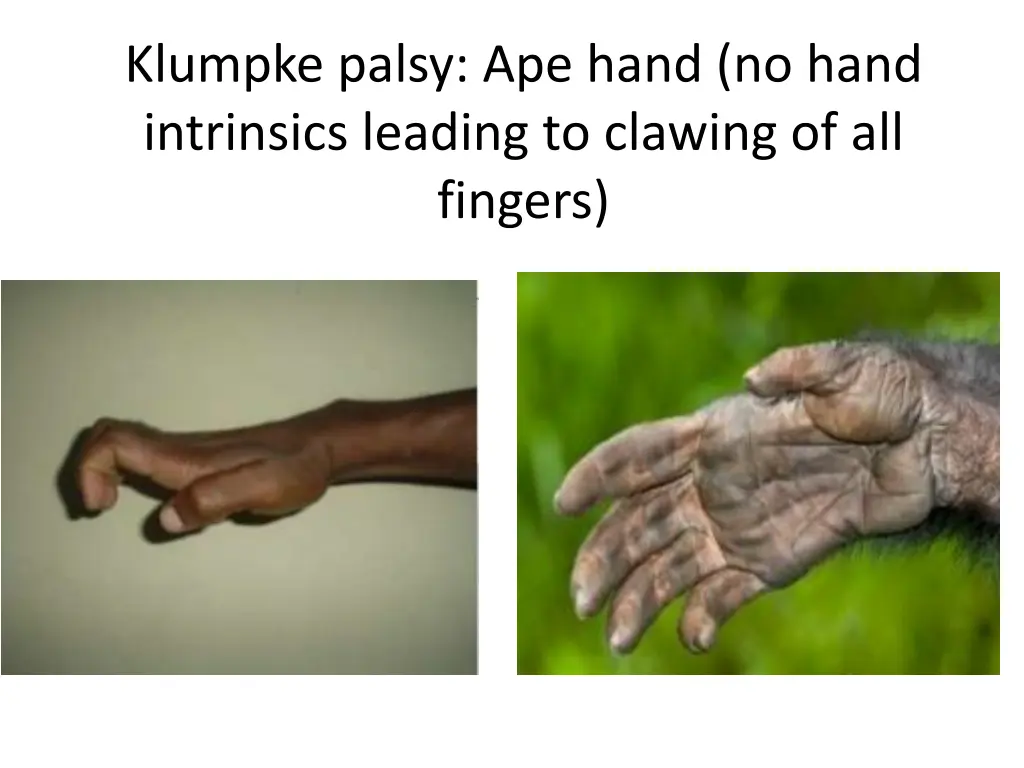 klumpke palsy ape hand no hand intrinsics leading