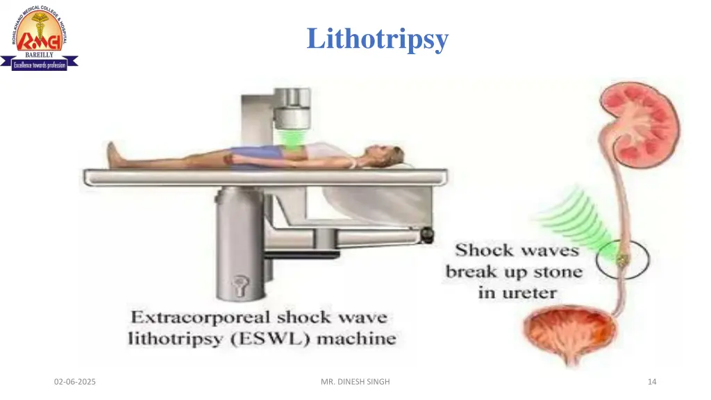 lithotripsy