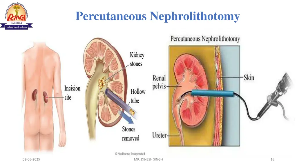percutaneous nephrolithotomy