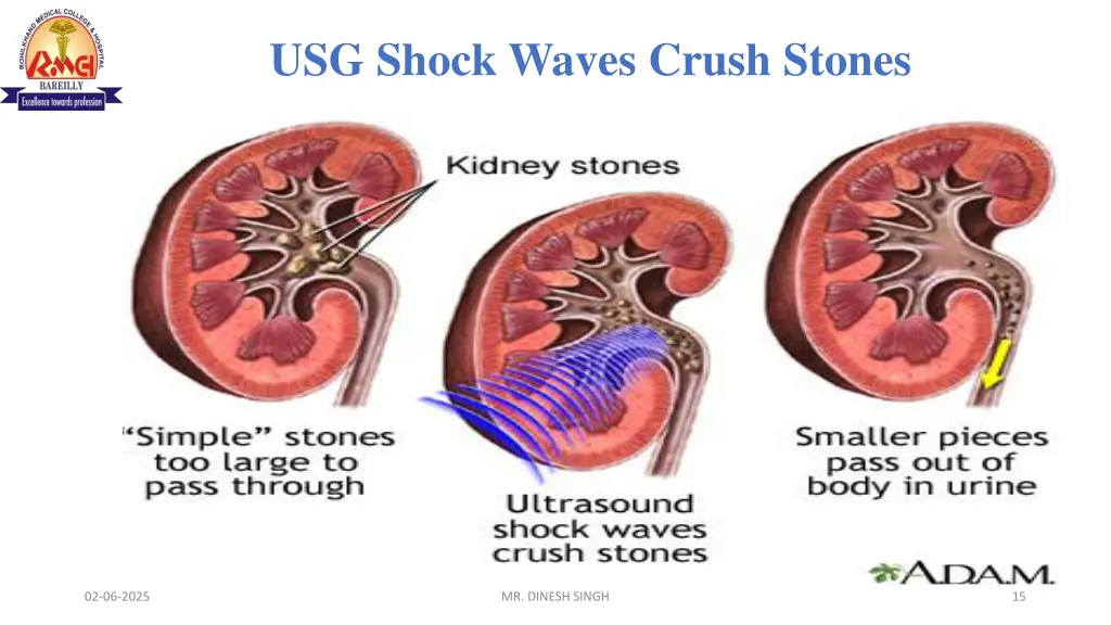 usg shock waves crush stones