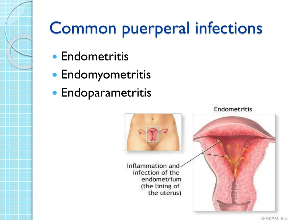 common puerperal infections