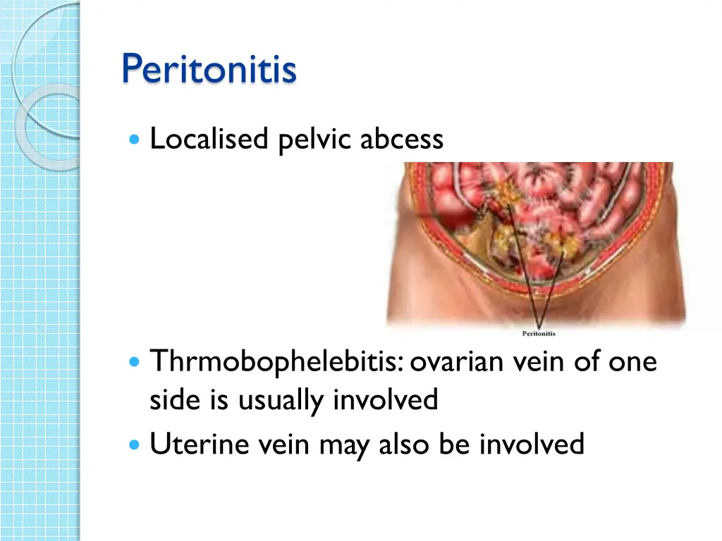 peritonitis