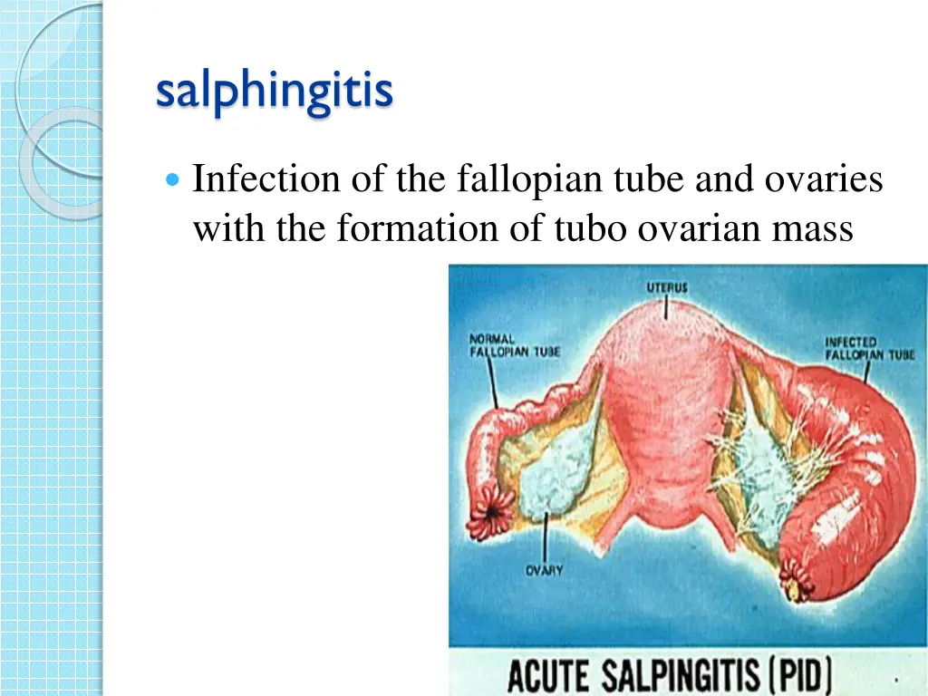 salphingitis