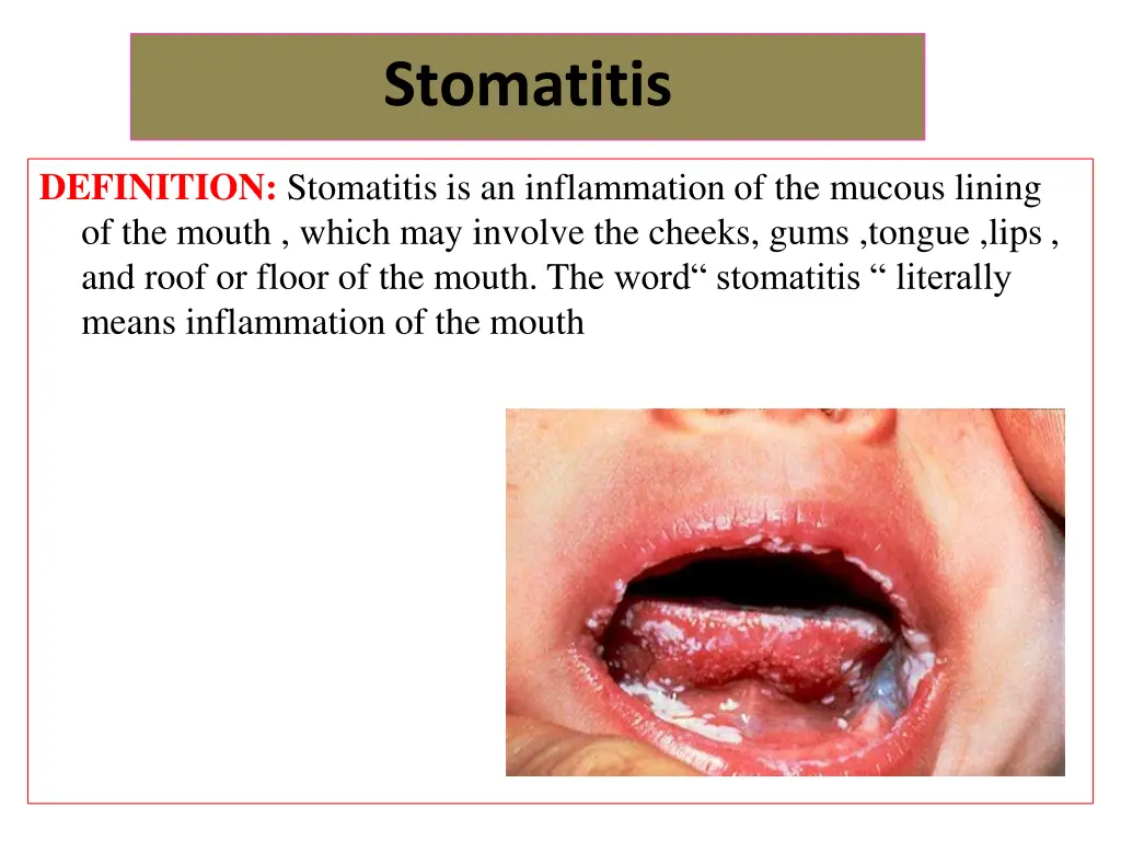 stomatitis