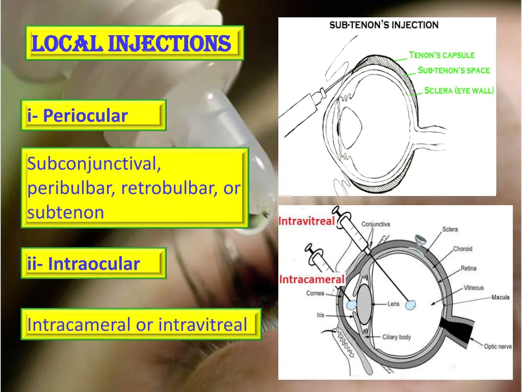 local injections local injections