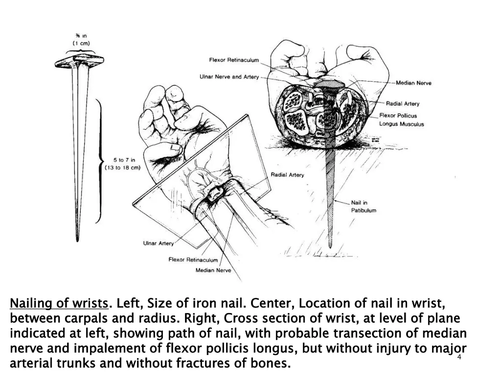 nailing of wrists between carpals and radius