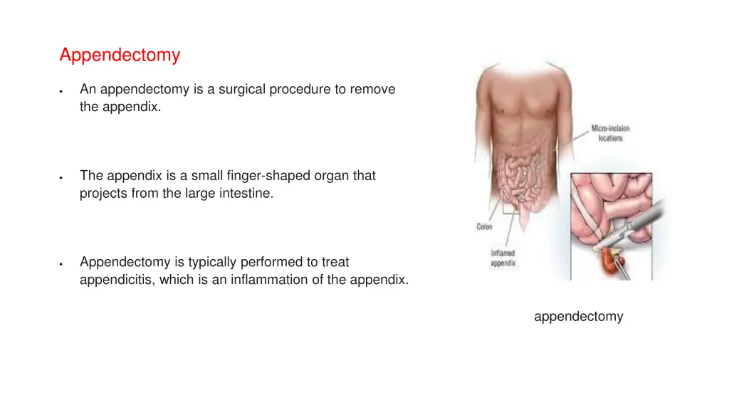 appendectomy