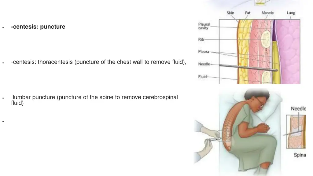 centesis puncture