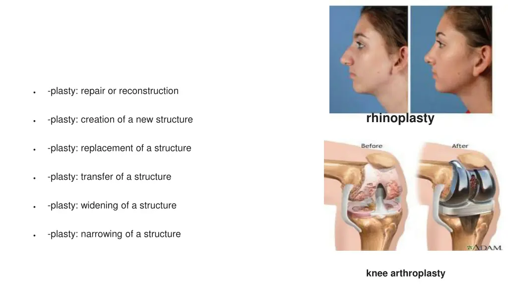 plasty repair or reconstruction