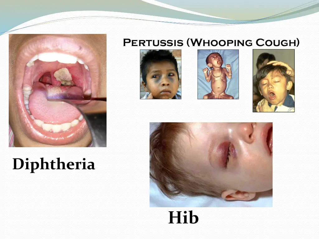 diphtheria