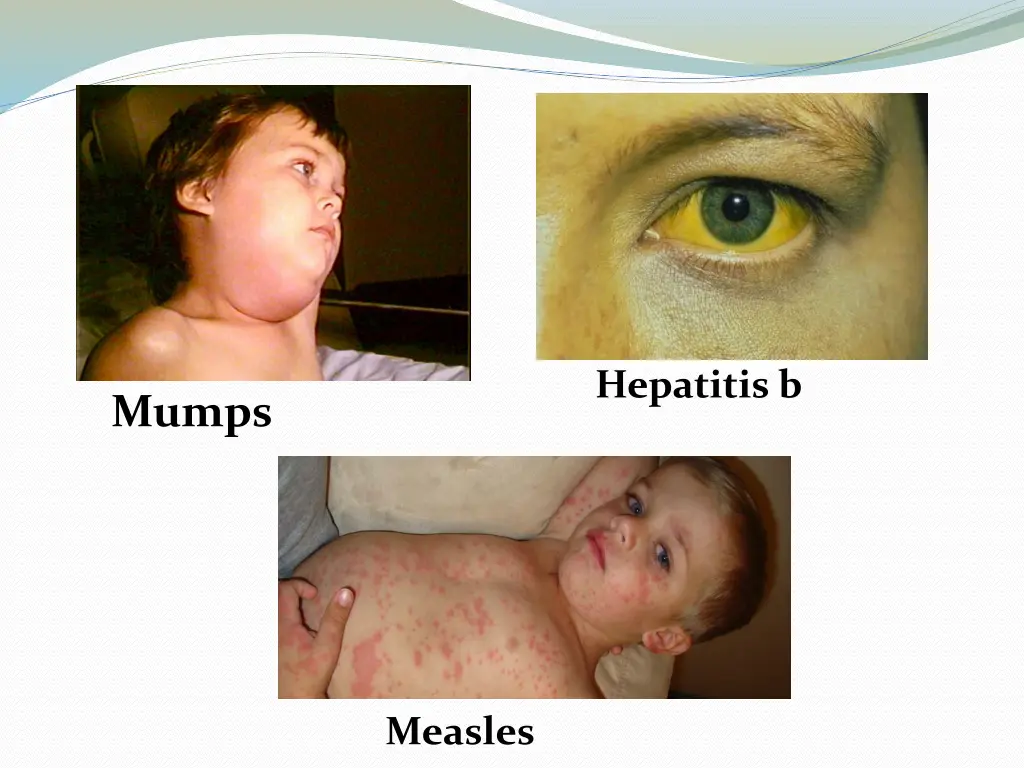 hepatitis b
