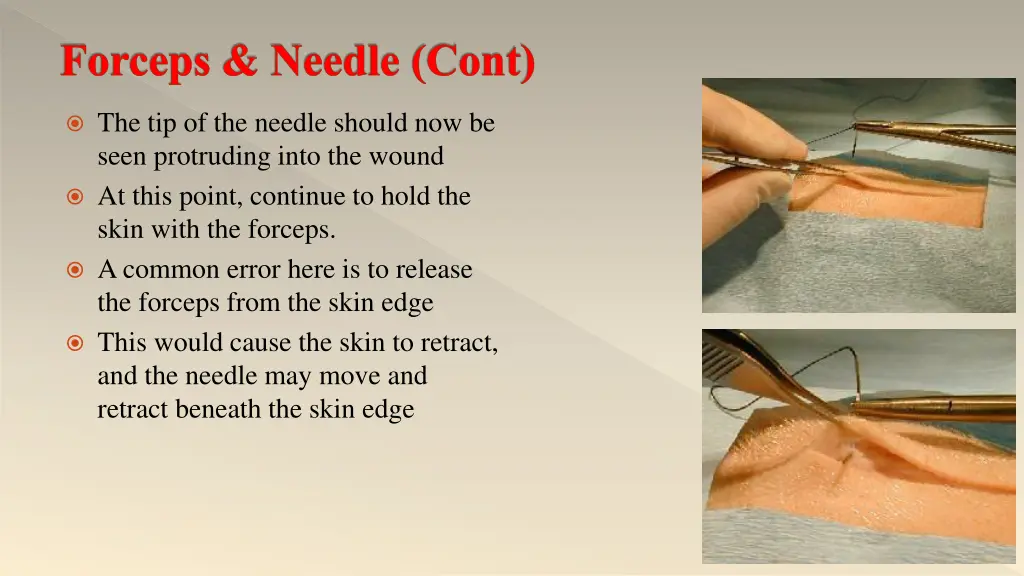 forceps needle cont