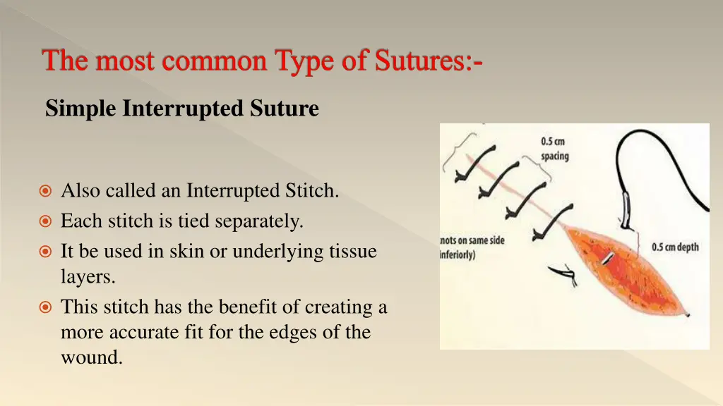 the most common type of sutures