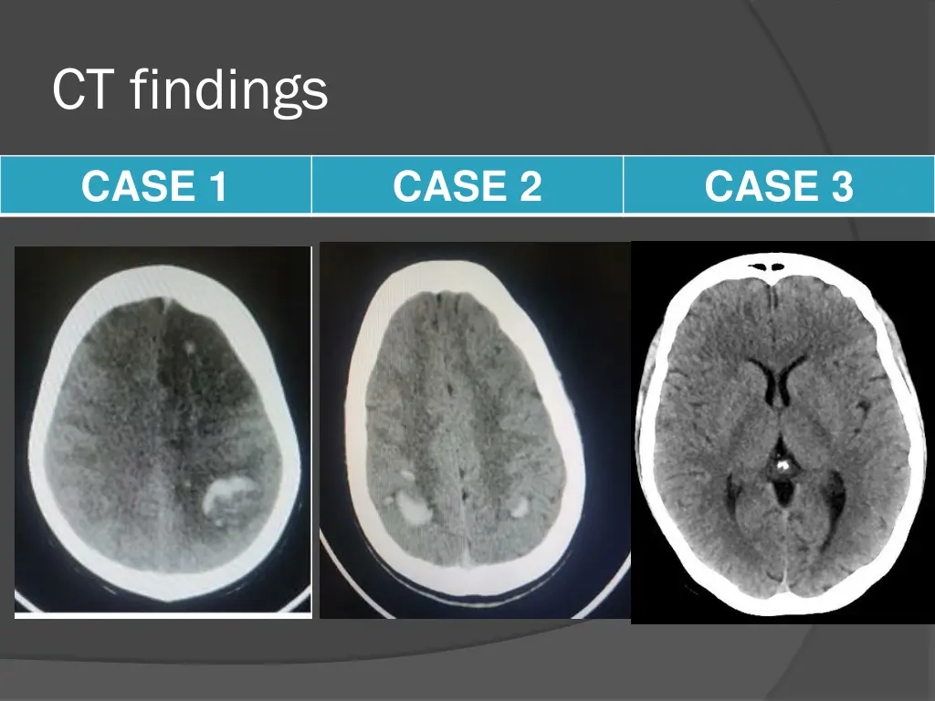 ct findings