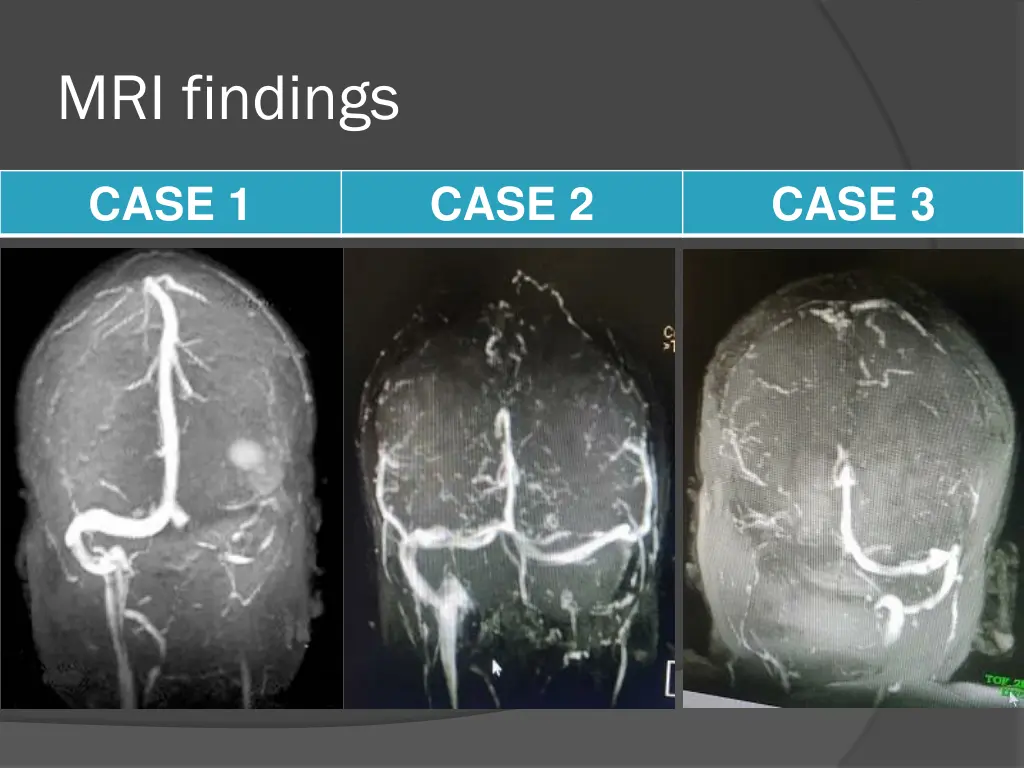 mri findings