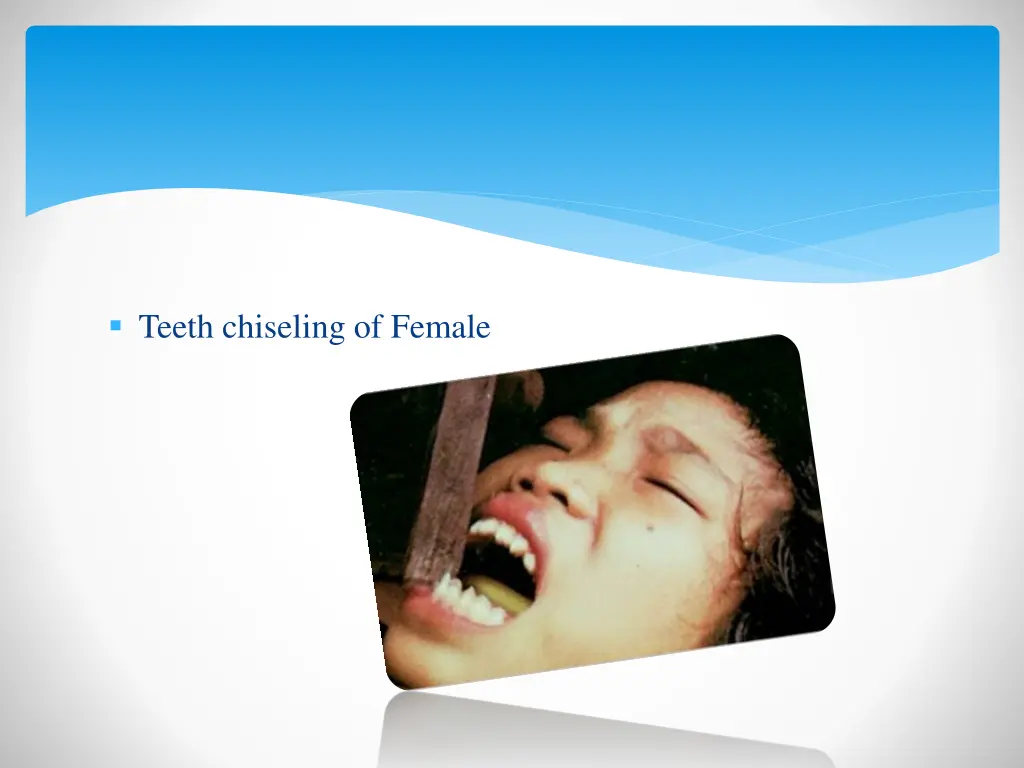 teeth chiseling of female
