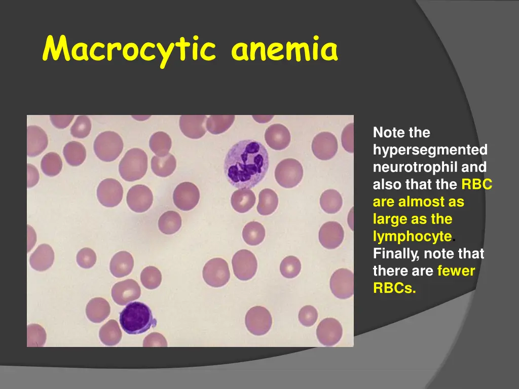 macrocytic anemia