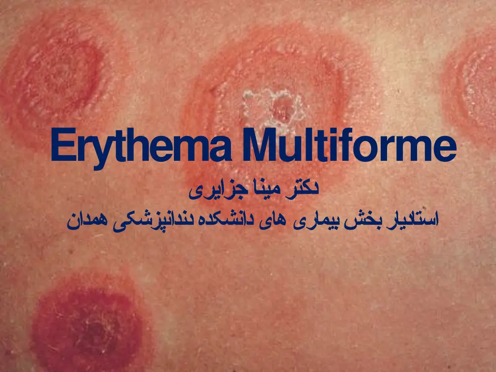 erythema multiforme