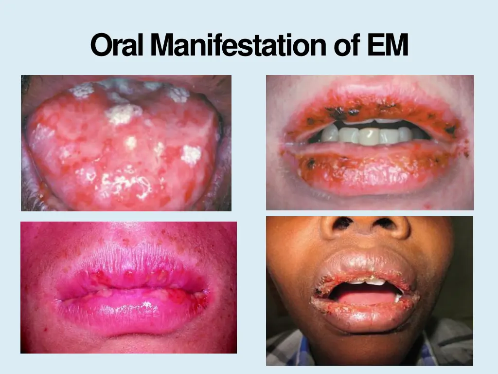 oral manifestation ofem 1