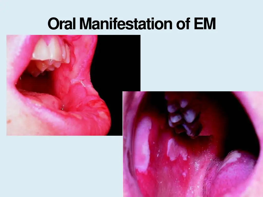 oral manifestation ofem 2