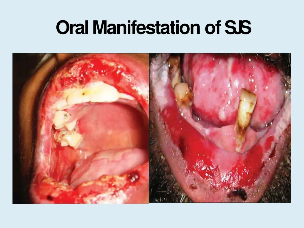 oral manifestation ofs j s 1