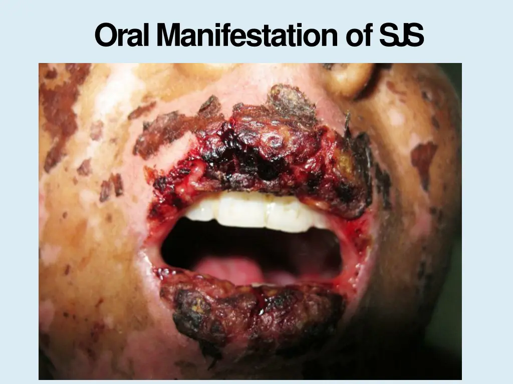 oral manifestation ofs j s 3