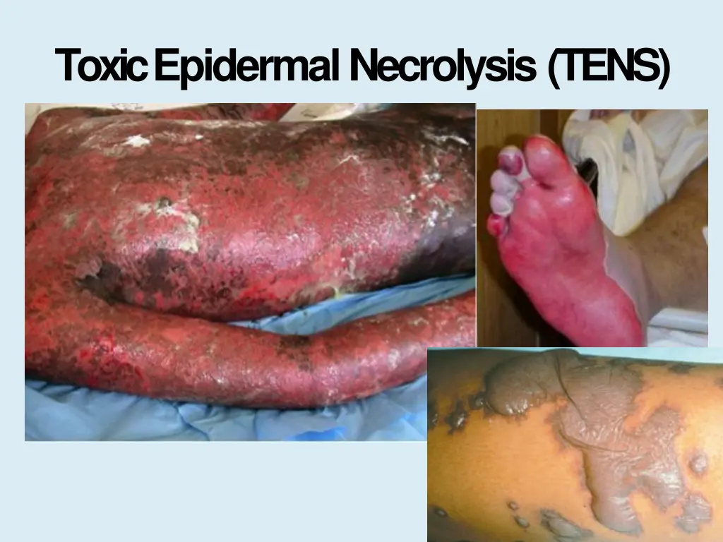 toxic epidermal necrolysis tens 1