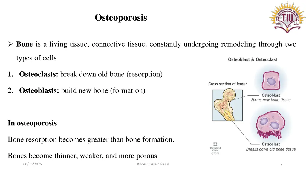osteoporosis 1
