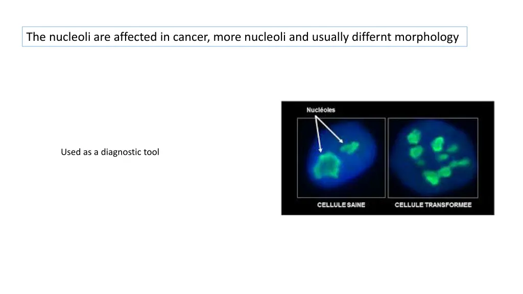 the nucleoli are affected in cancer more nucleoli