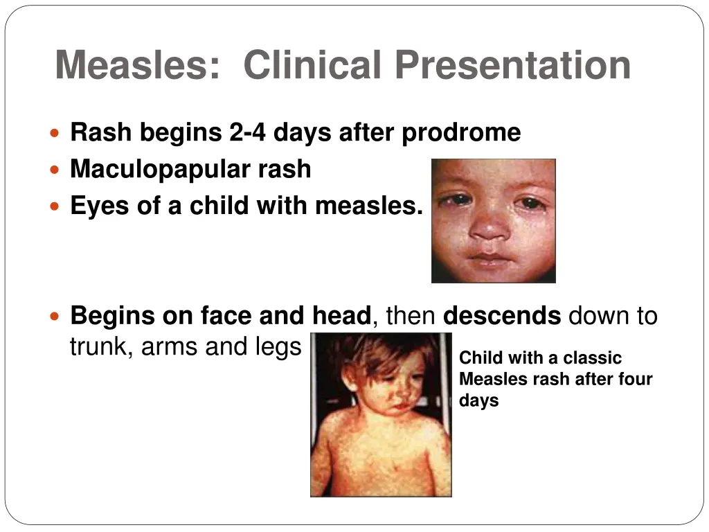 measles clinical presentation 1