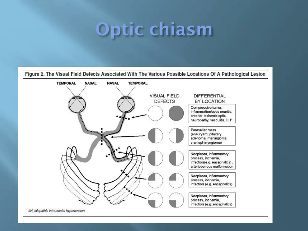 optic chiasm