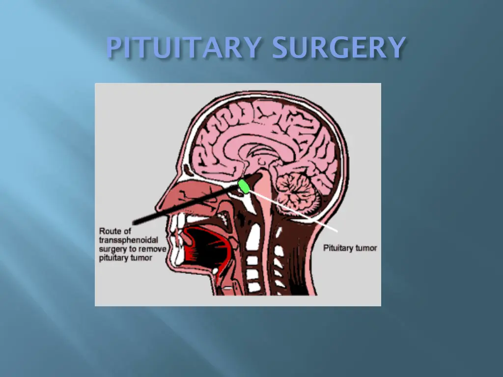 pituitary surgery