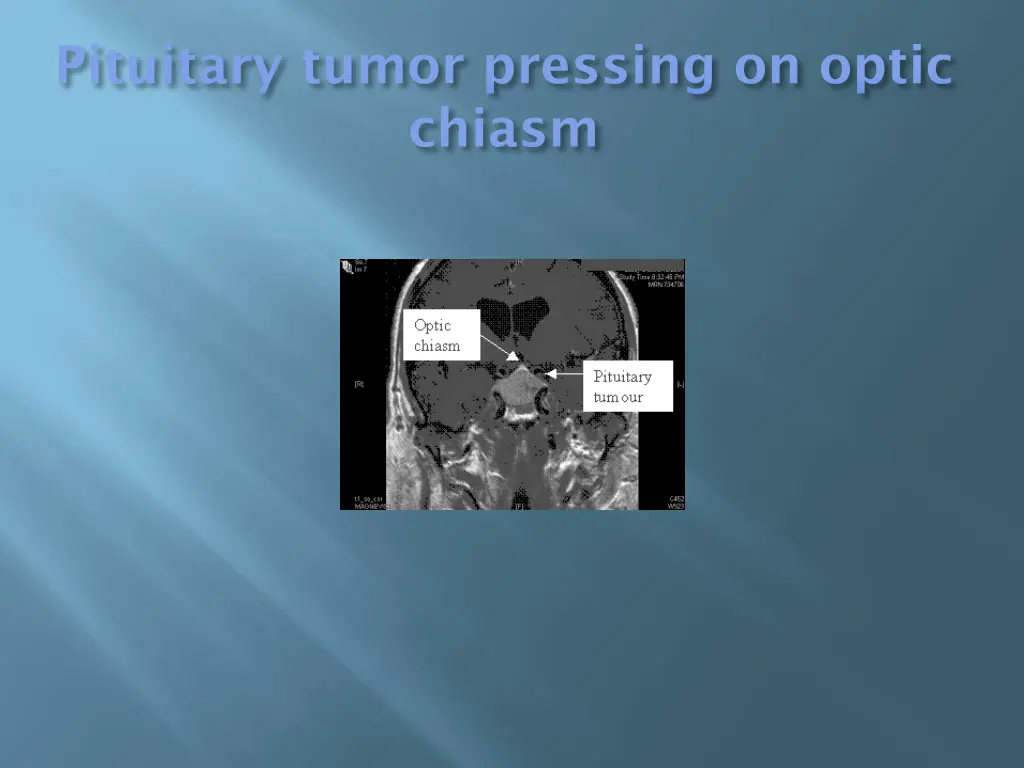 pituitary tumor pressing on optic chiasm