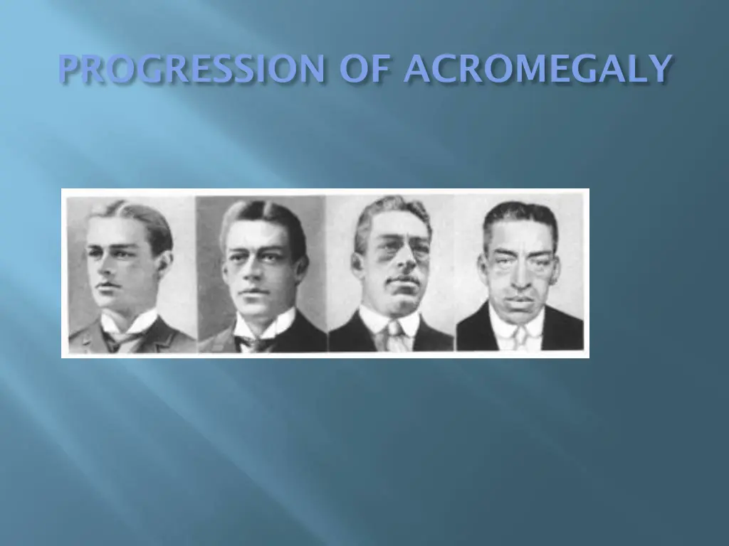 progression of acromegaly