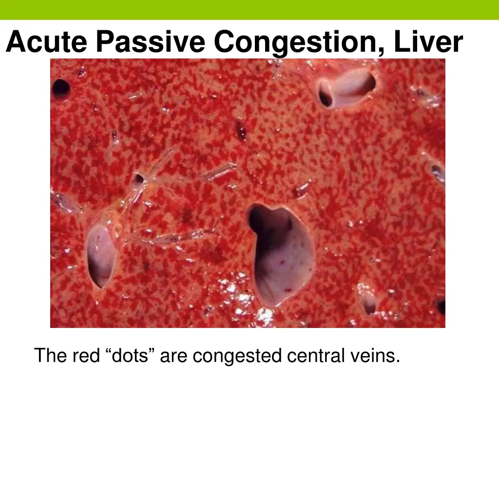 acute passive congestion liver