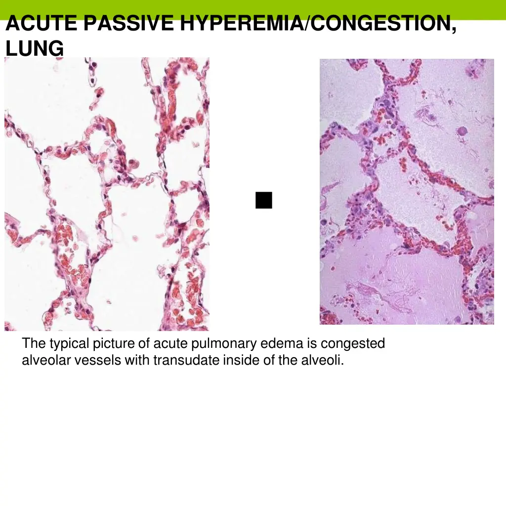 acute passive hyperemia congestion lung