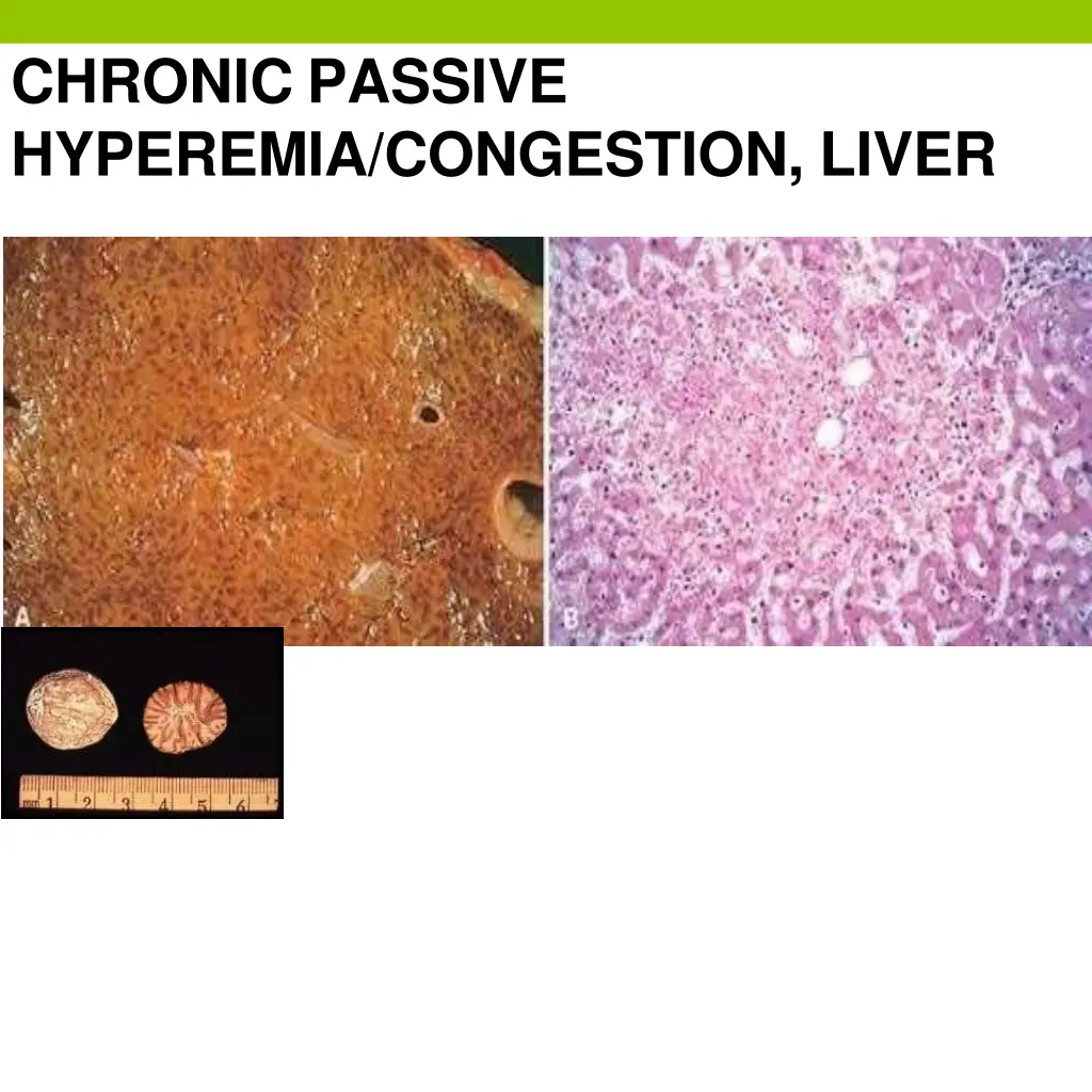 chronic passive hyperemia congestion liver