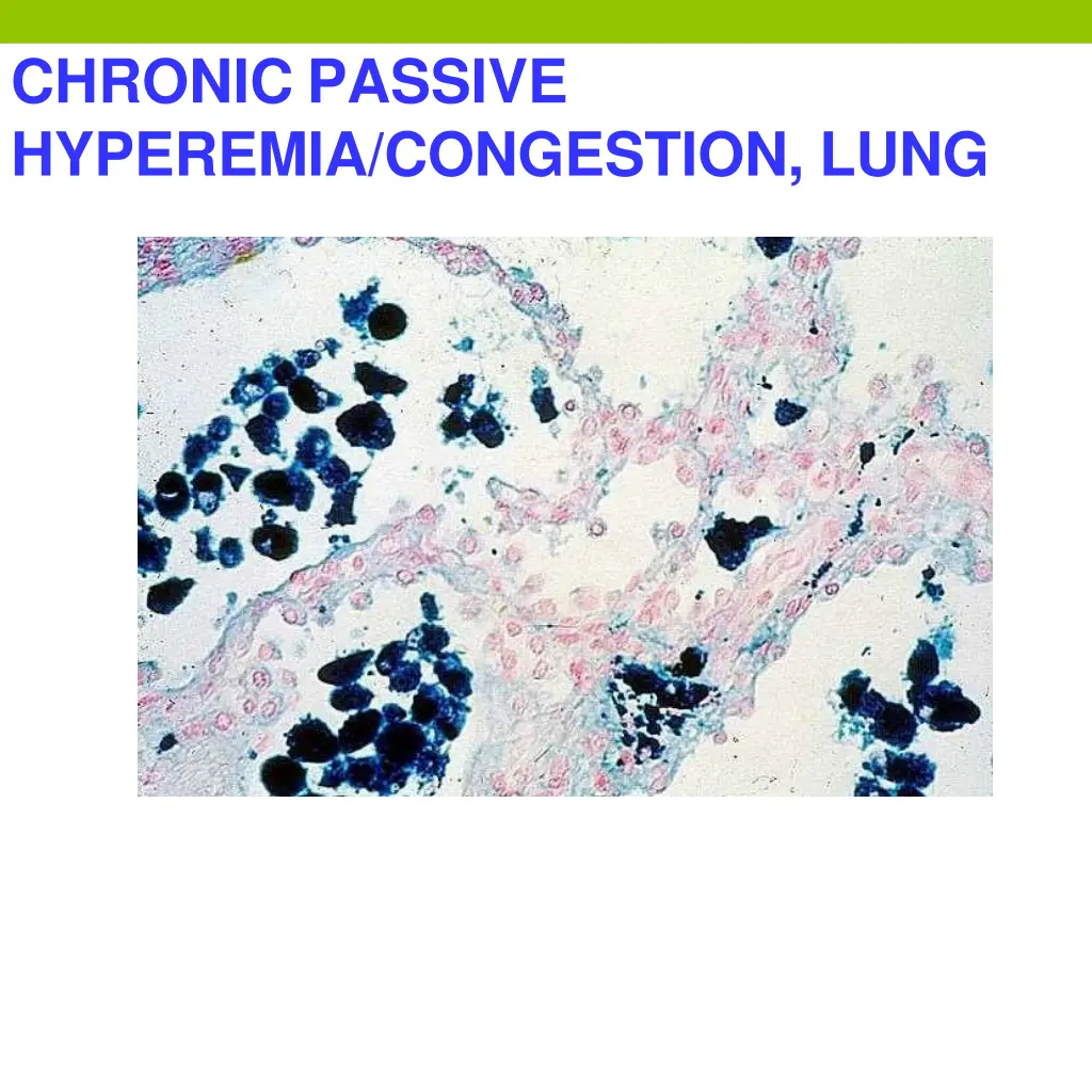 chronic passive hyperemia congestion lung