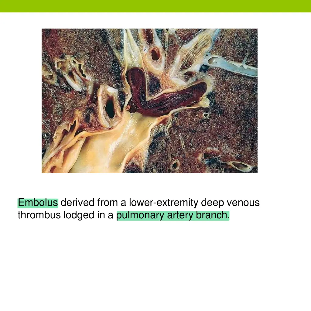 embolus derived from a lower extremity deep