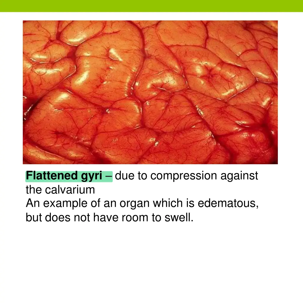 flattened gyri due to compression against