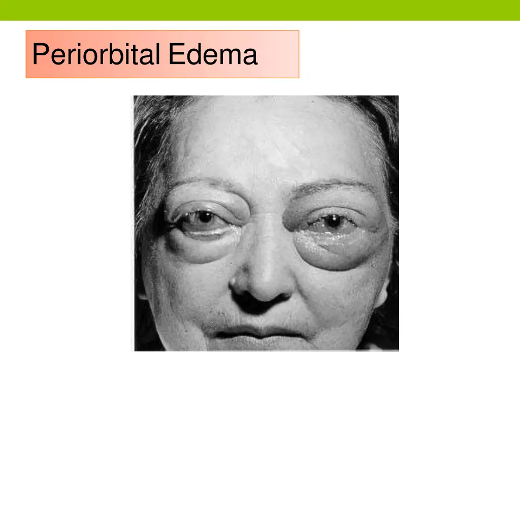 periorbital edema