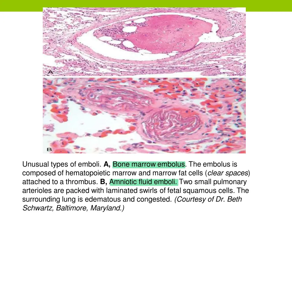 unusual types of emboli a bone marrow embolus
