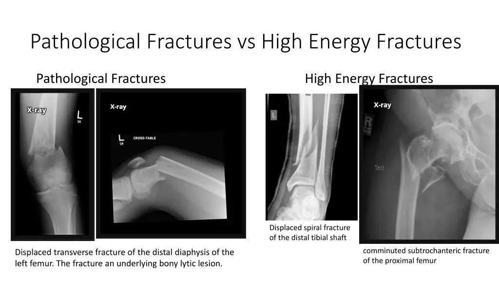 pathological fractures vs high energy fractures 1