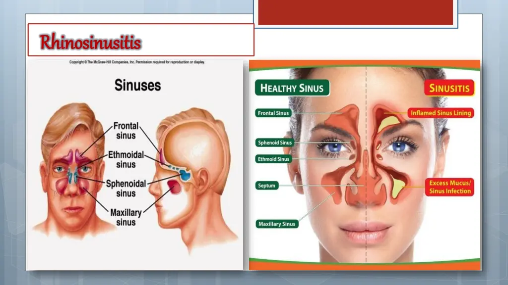 rhinosinusitis rhinosinusitis