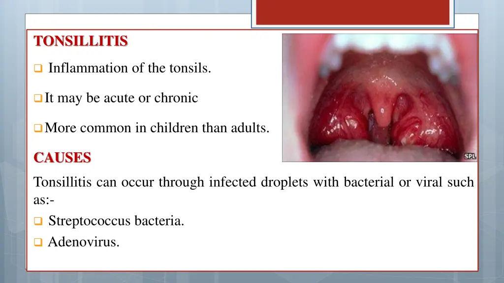 tonsillitis