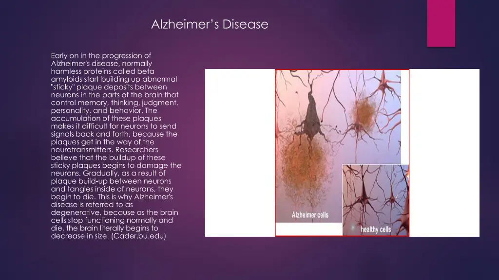 alzheimer s disease