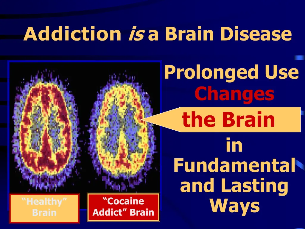 addiction is a brain disease